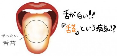 舌が白いのは病気かもしれない?
