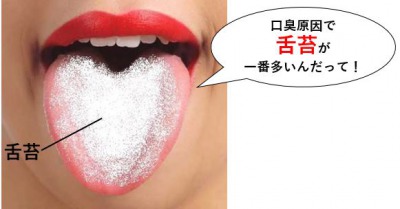 口臭原因で舌苔が一番多い
