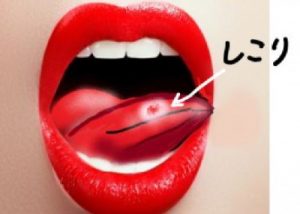 舌がんと口内炎の違い 見分け方と注意する4つのポイント