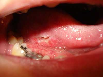 舌の縁にできた傷のような癌