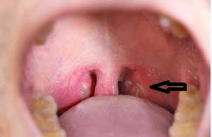 喉の奥に見える膿栓
