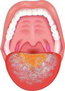 舌が白いと口臭になる 舌磨きのポイントは舌を傷つけないこと