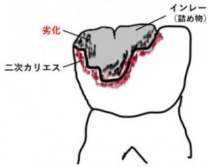 銀歯の劣化
