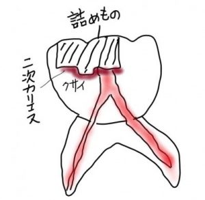 詰め物の二次カリエスから口臭がする