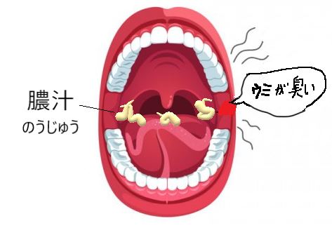 喉の臭い液(膿汁)