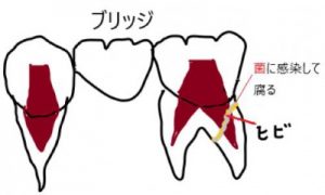 ブリッジの歯根が破折する