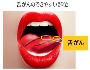 舌がんと口内炎の違い 見分け方と注意する4つのポイント