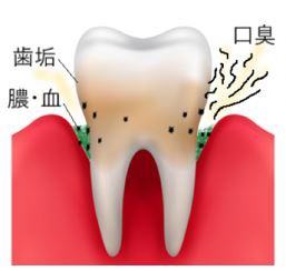 歯周病はうがいで治る アルカリイオン水うがいで進行が防げる