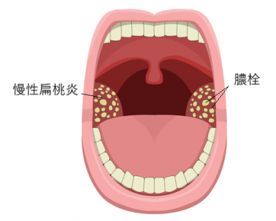 慢性扁桃炎で膿栓ができる