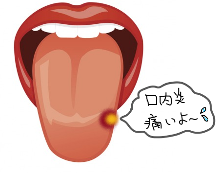 舌裏の口内炎が痛い