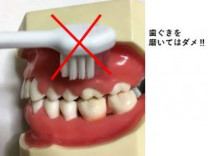 歯茎から血が出る 歯磨き粉