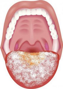 ひどい舌苔の図