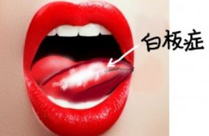 癌化する白板症