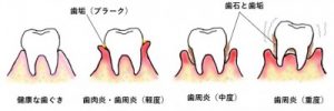 歯周病の進行レベル