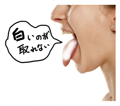 舌の白い(舌苔)が取れない