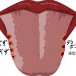 舌のふちがでこぼこ！歯型の原因と治し方