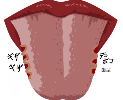舌にデコボコの歯型ができた