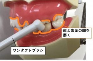 奥歯の奥が臭いのは膿栓だけの原因ではない