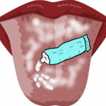 歯磨き粉で舌がヒリヒリする！舌の痛み３つの原因