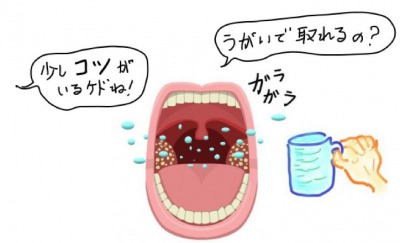耳鼻科 臭い玉 膿栓（臭い玉）と口臭 横浜・中川駅前歯科