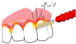 歯周病のセルフチェック こうすれば歯周病の程度がわかります